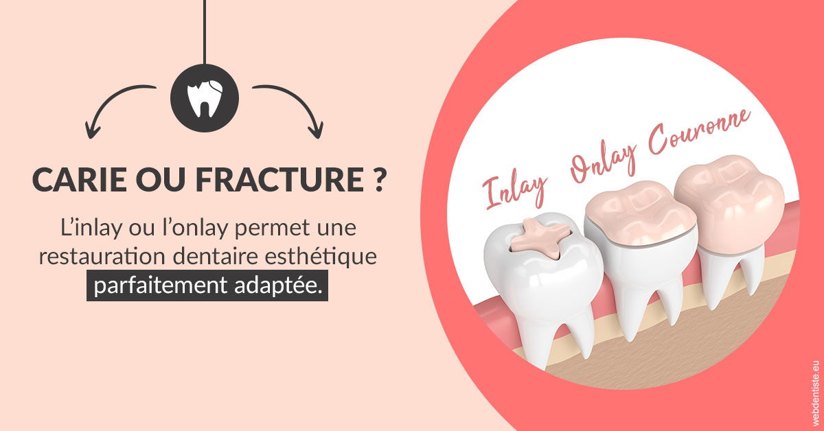 https://dr-gregori-laetitia.chirurgiens-dentistes.fr/T2 2023 - Carie ou fracture 2
