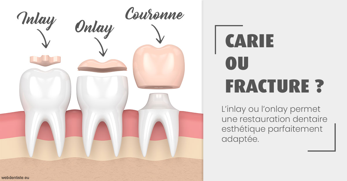 https://dr-gregori-laetitia.chirurgiens-dentistes.fr/T2 2023 - Carie ou fracture 1