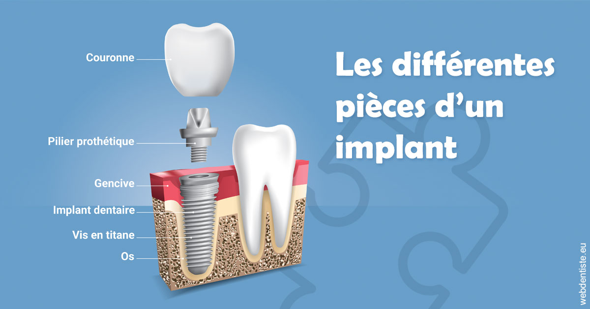 https://dr-gregori-laetitia.chirurgiens-dentistes.fr/Les différentes pièces d’un implant 1